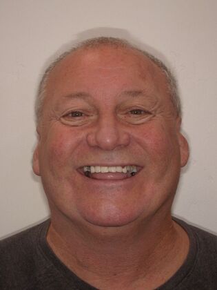 NuSmile Transformations Scott  - Before