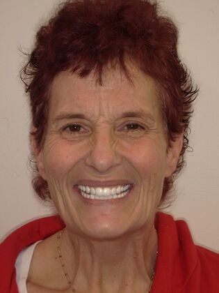 NuSmile Transformations Robyn  - After