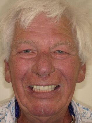 NuSmile Transformations Bob - After