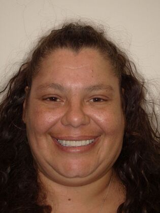 NuSmile Transformations Stephanie - After