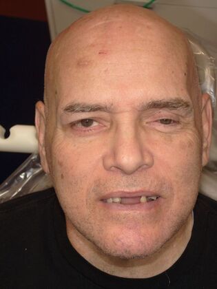 NuSmile Transformations Doug 2 - Before