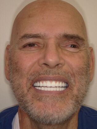 NuSmile Transformations Doug 2 - After