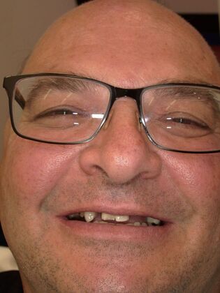 NuSmile Transformations Kevan  - Before