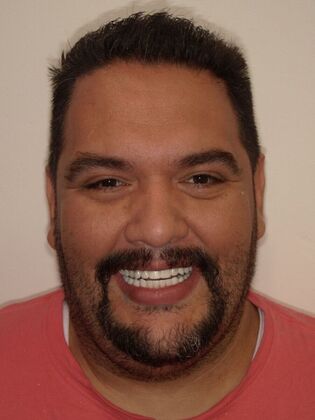 NuSmile Transformations Art  - After