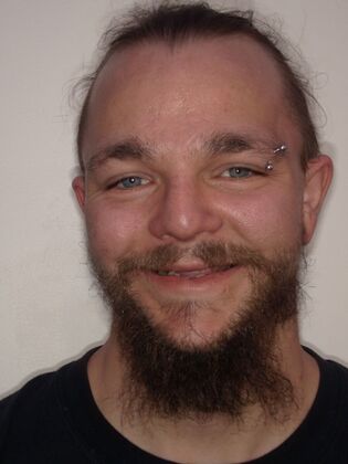 NuSmile Transformations Kavan  - Before