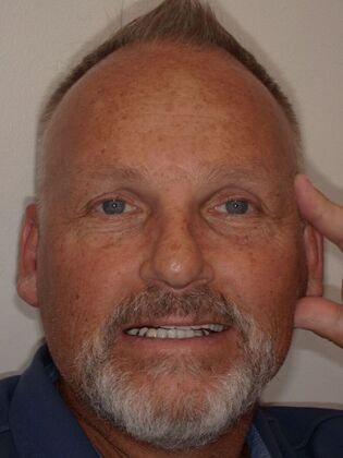 NuSmile Transformations Robert  - Before