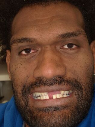 NuSmile Transformations Iliesa  - Before