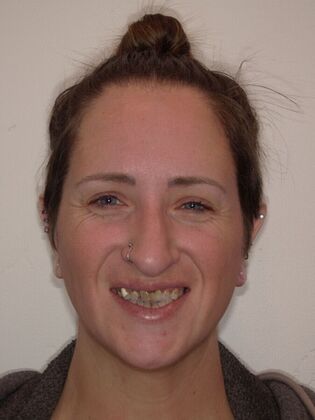 NuSmile Transformations Breanne  - Before
