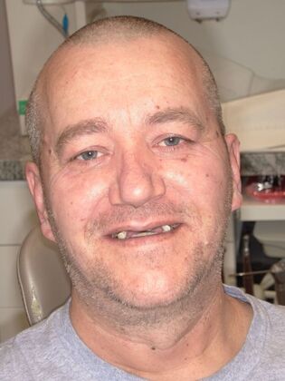 NuSmile Transformations Anton - Before