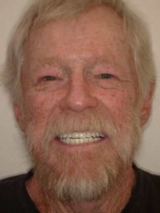 NuSmile Transformations Duane - After