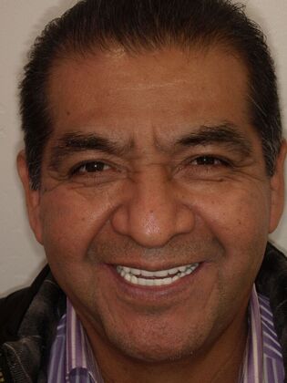 NuSmile Transformations Saul  - After