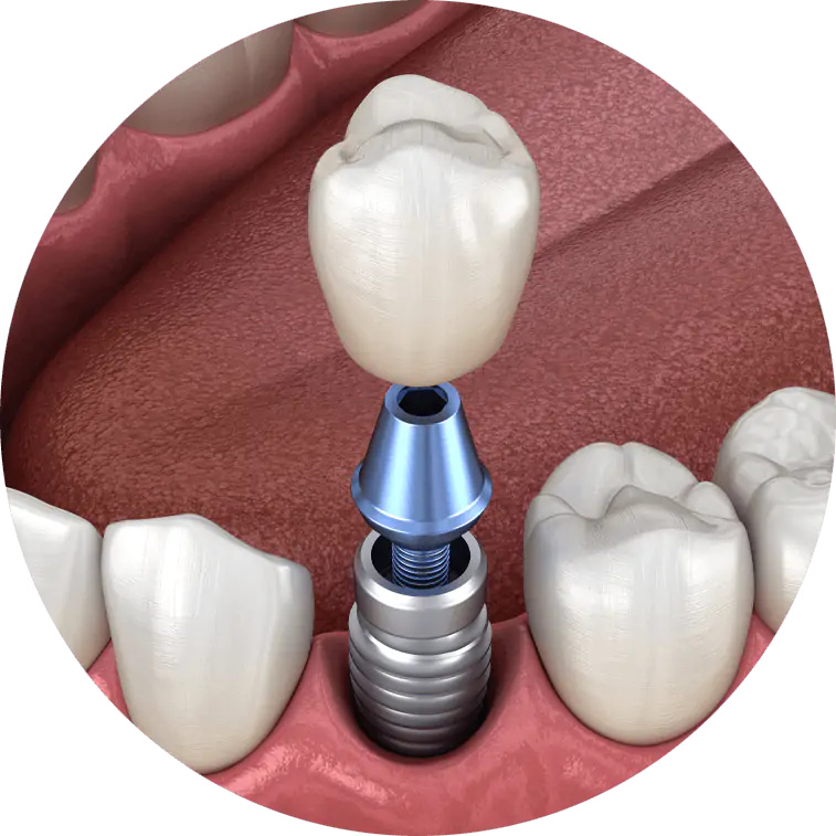 Illustration showing dental implants
