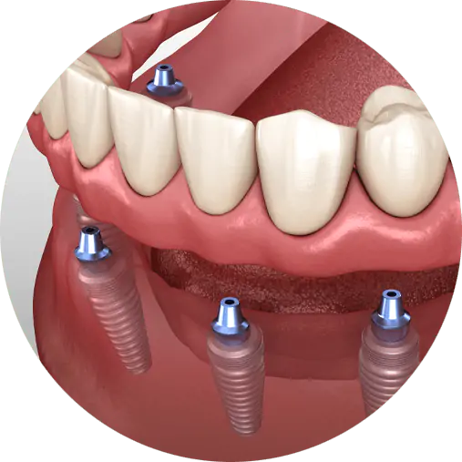 illustration showing implant supported dentures